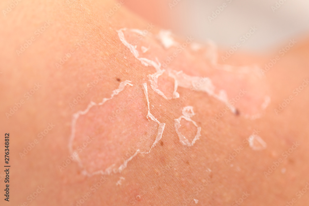 Fototapeta premium Skin peeling after sunburn