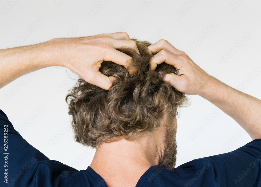 Naklejka premium a man with a fungus of the head and dandruff scratching his head. the concept of scalp and hair diseases and male health