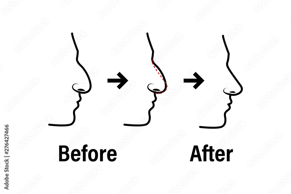 Rhinoplasty before and after the procedure infographics. Nose plastic