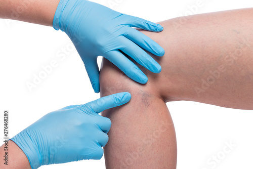 hands of doctor examine varicose veins on female leg, vessels close up