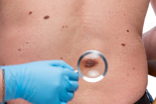 Obraz na plátne Dermatologist examining the skin on the back of a patient