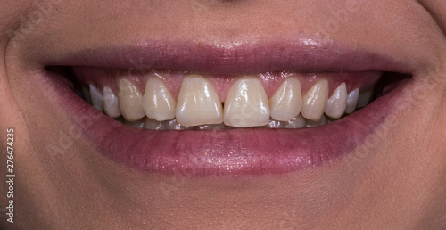 Woman smile with natural teeth