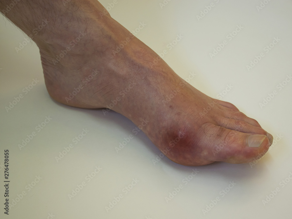 .Foot disease Rheumatism and gout. Red leg swelling. Pain in the foot