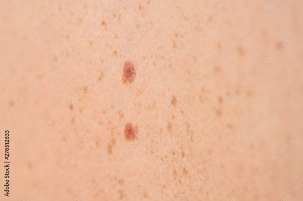 Close up detail of the bare skin on a man back with scattered moles and freckles. Checking benign moles. Sun effect on skin. Birthmarks on skin Close up detail of the bare skin on a man back with scattered moles and freckles. Checking benign moles. Sun effect on skin. Birthmarks on skin