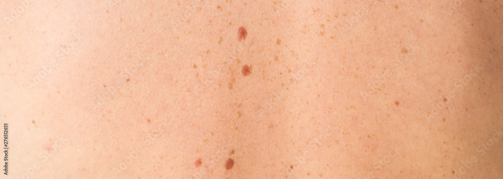 Close up detail of the bare skin on a man back with scattered moles and freckles. Checking benign moles. Sun effect on skin. Birthmarks on skin Close up detail of the bare skin on a man back with scattered moles and freckles. Checking benign moles. Sun effect on skin. Birthmarks on skin