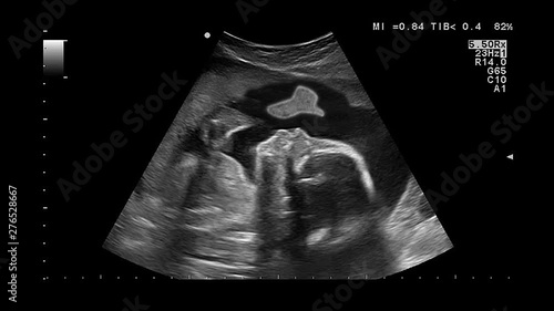 Medical examination by ultrasound of a pregnant woman. Unborn baby gives thumb up in the womb. Modern ultrasound examination during pregnancy. Seamlessly loop conceptual footage