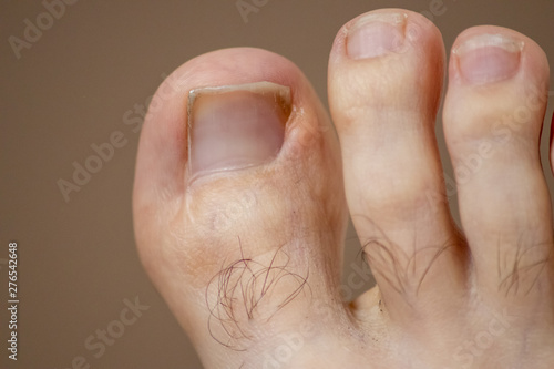 Eingewachsener Zehennagel mit Granulationsgewebe und einer Narbe von einer erfolgreichen OP in Form einer NagelbettverkleinerungNagelbett photo