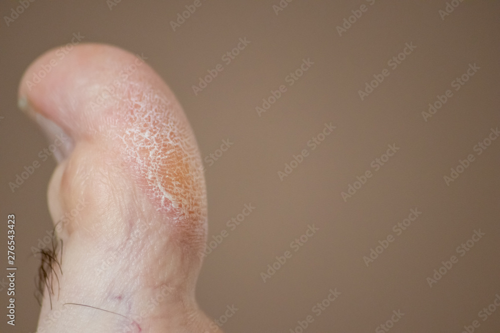 Foto de Großer Zeh mit Hornhaut, Schwielen und Fußpilz bedarf der Behandlung eines Mediziners