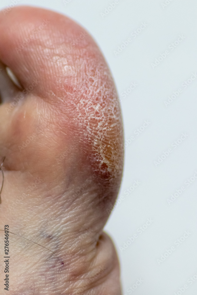 Großer Zeh mit Hornhaut, Schwielen und Fußpilz bedarf der Behandlung eines Mediziners oder
