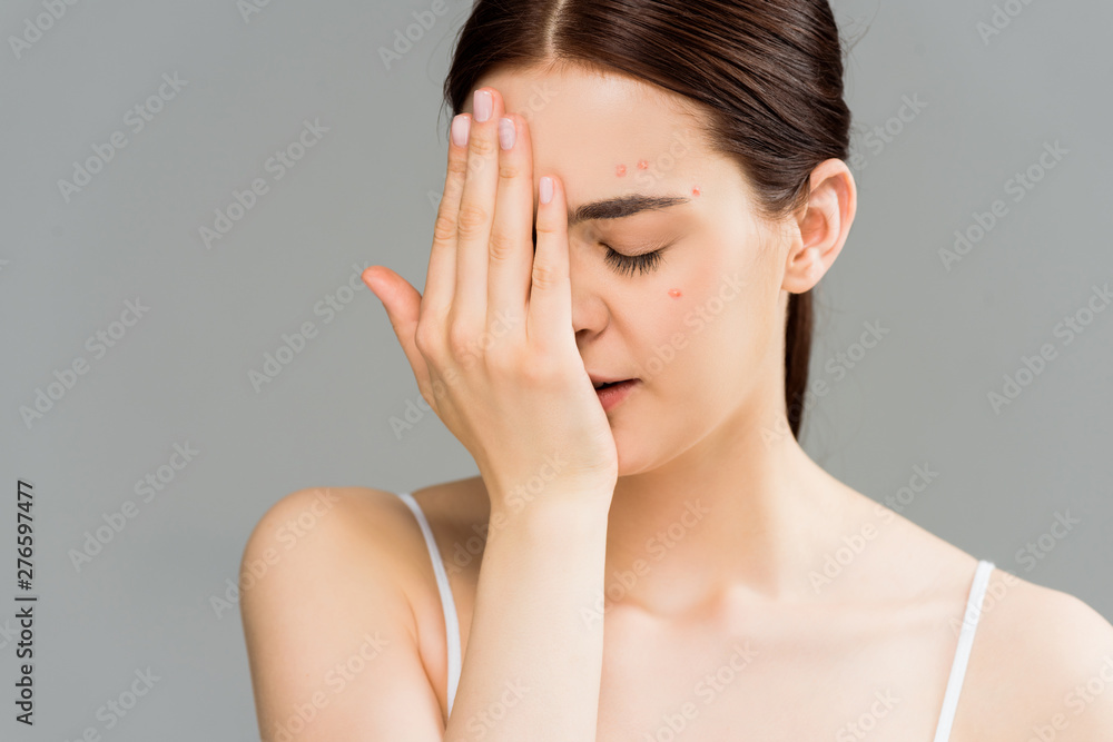 young woman with acne covering face with hand isolated on grey young woman with acne covering face with hand isolated on grey