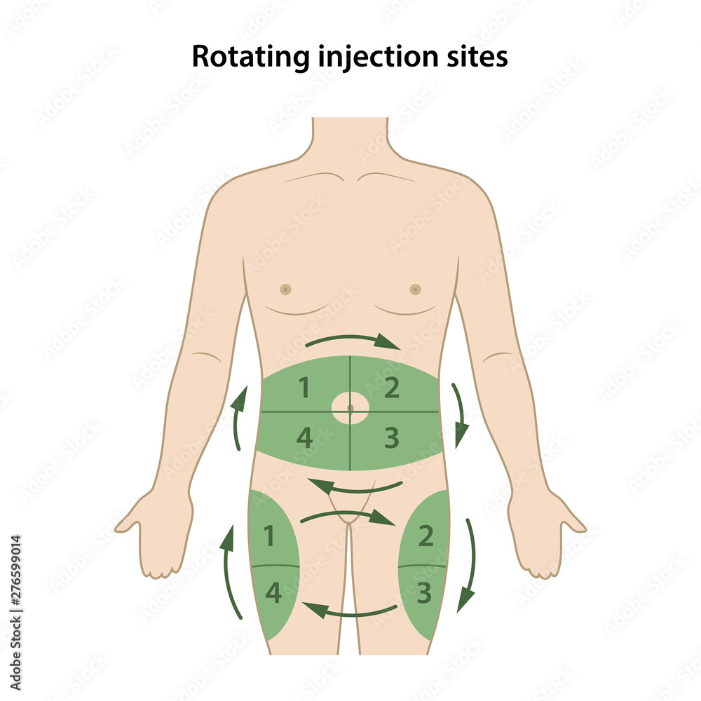 Diabetes. The circle of injection sites is shown on the male body by ...