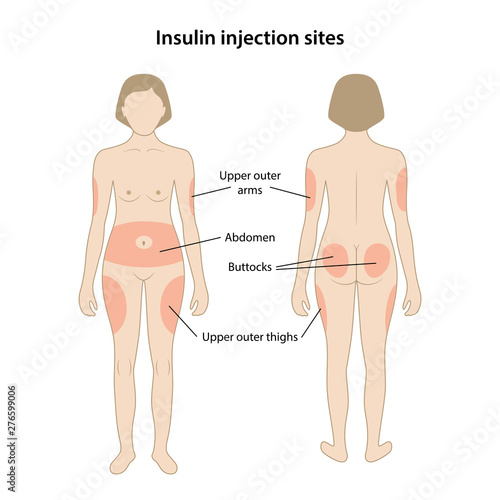 Diabetes. Insulin injection sites shown on the female body: upper outer arms, abdomen, buttocks, upper outer thighs. Anatomical vector illustration in flat style isolated over white background.