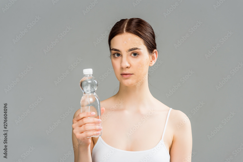 young woman with problem skin holding bottle with water isolated on grey young woman with problem skin holding bottle with water isolated on grey