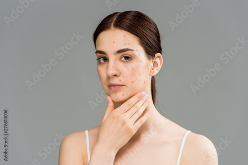 beautiful young woman with pimples touching face isolated on grey photo