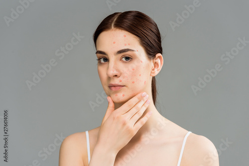 Quadro su tela beautiful young woman with pimples touching face isolated on grey