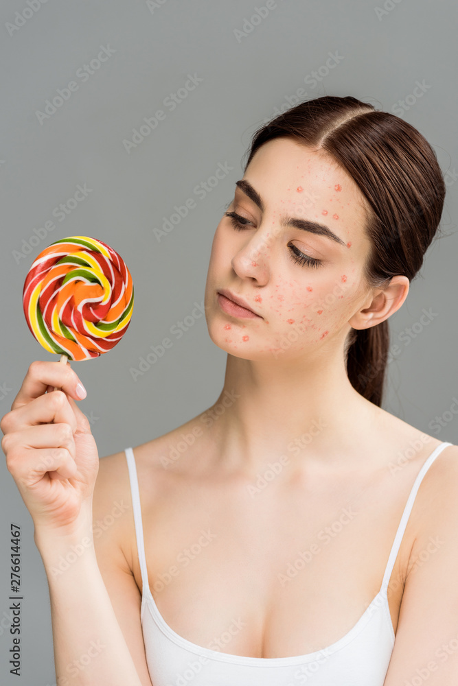 young brunette woman with acne on face looking at sweet lollipop isolated on grey