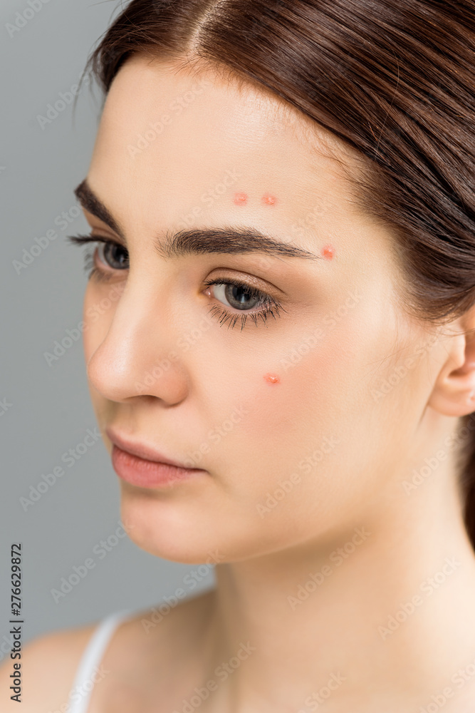 Fototapeta premium upset young woman with acne on face isolated on grey