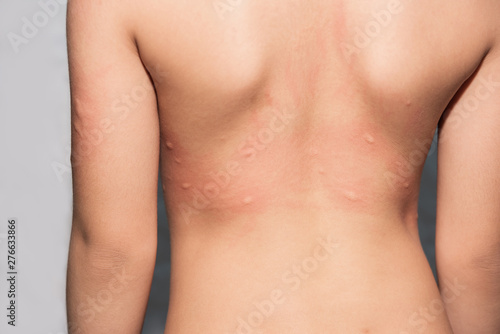 Rash on the child skin from insect bites or mosquitoes