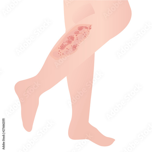 psoriasis skin disease