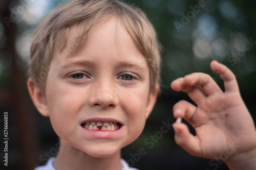 6 years old boy shows the ruptured milk tooth