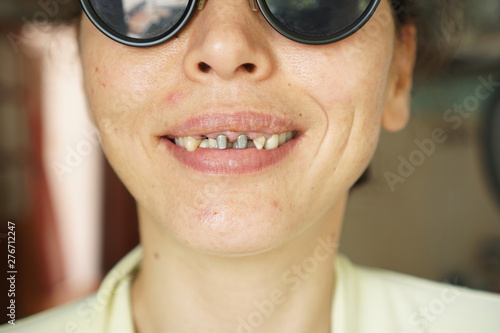 Fototapeta Ugly toothless young woman smiling