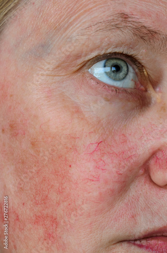 Woman face skin with vascular stars and couperose. photo