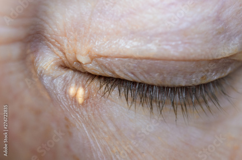 Close up of woman eyes with Xanthelasma on the eyelids. Hypercholesterolemia, high cholesterol.
