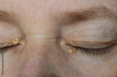 Close up of woman eyes with Xanthelasma on the eyelids. Hypercholesterolemia, high cholesterol.