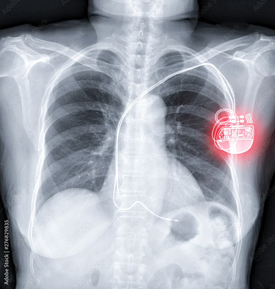Chest Xray or XRay Image Of Human Chest with pacemaker placement or