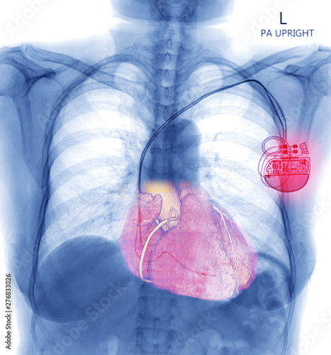 Fotografie Chest X-ray or X-Ray Image Of Human Chest with pacemaker placement or Cardiac Pacemakers for control heart in patient arrhythmia
