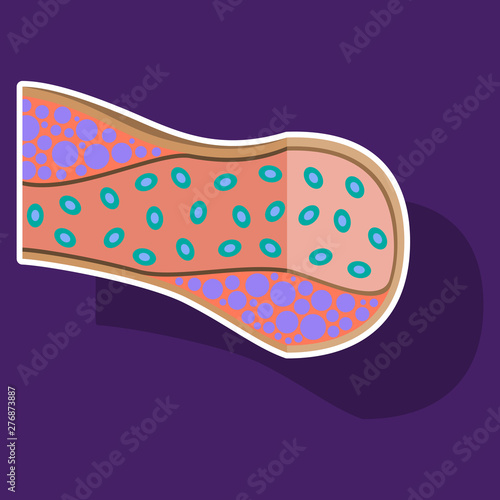 Sticker vienna human atherosclerosis.the structure of a veins . the veins in the manifestation of the disease