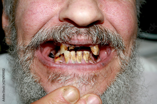 Rotten bad teeth. Beard and mustache. Caries. Periodontal disease. Dental tartar.