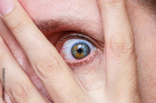 Tableau sur toile Caucasian woman Scared eye, look through fingers