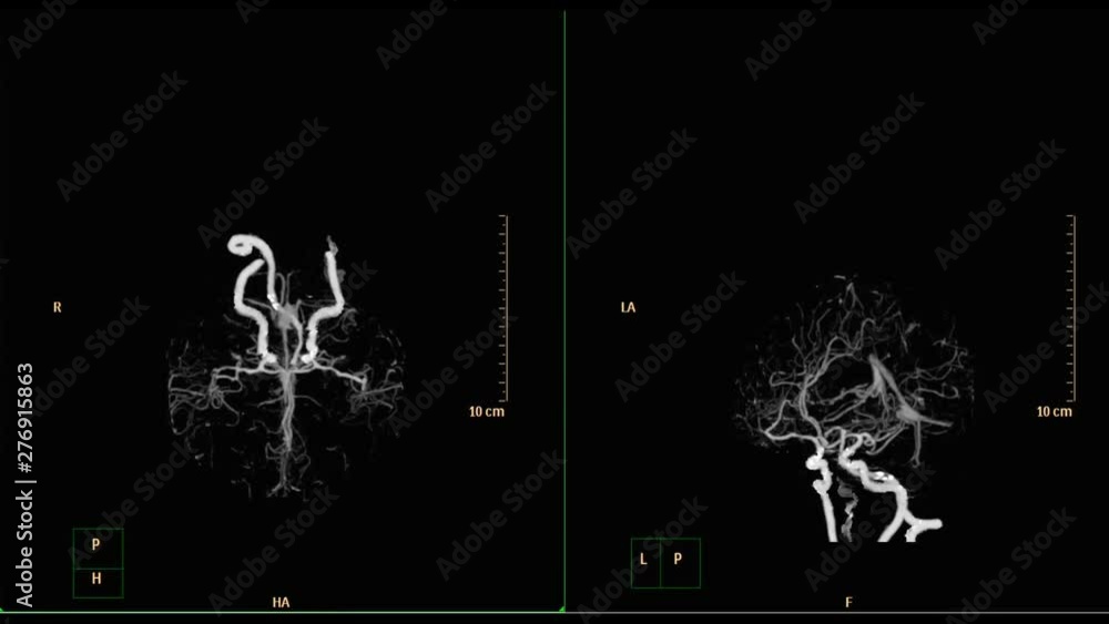 CTA brain include neck 3D volume rendering image turn around on the screen showing common carotid artery. medical technology concept. CTA brain include neck 3D volume rendering image turn around on the screen showing common carotid artery. medical technology concept.