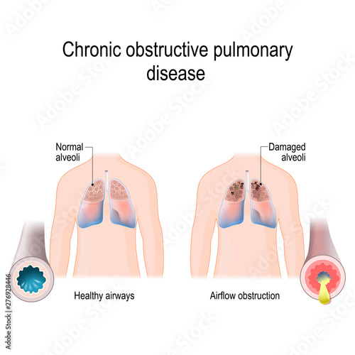 Chronic obstructive pulmonary disease (COPD)