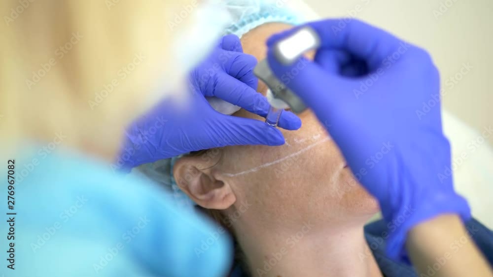 The concept of contour plastic face. A plastic surgeon injects a filler injection into the face of a woman. close-up. The concept of contour plastic face. A plastic surgeon injects a filler injection into the face of a woman. close-up.