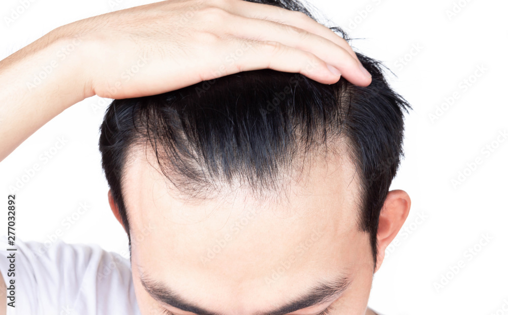 Young man serious hair loss problem for health care medical and shampoo product concept Young man serious hair loss problem for health care medical and shampoo product concept