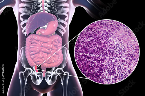 Acute appendicitis, 3D illustration of human body with inflammed appendix and light micrograph, photo under microscope photo