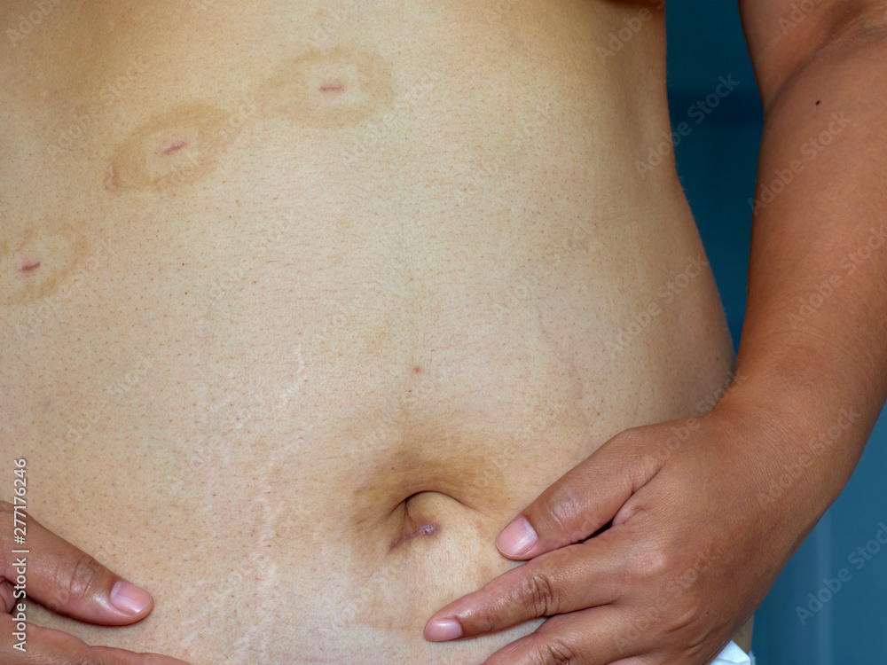 Scars on the skin from surgery Scars on the skin from surgery