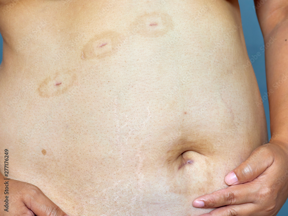 Fototapeta premium Scars on the skin from surgery