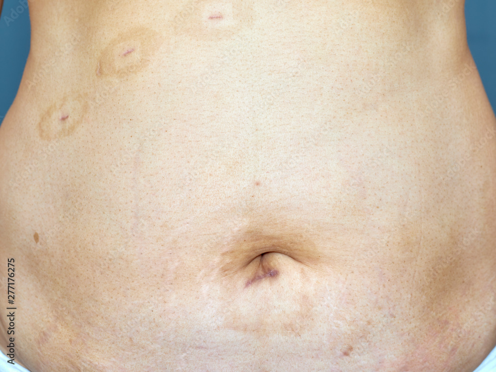 Scars on the skin from surgery Scars on the skin from surgery