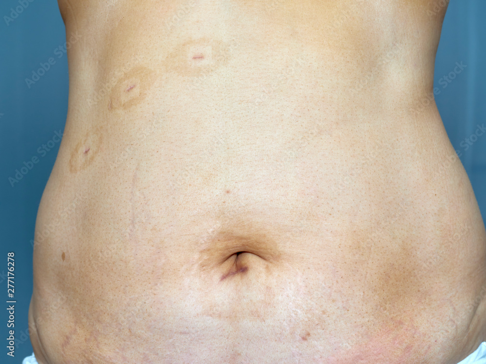 Fototapeta premium Scars on the skin from surgery
