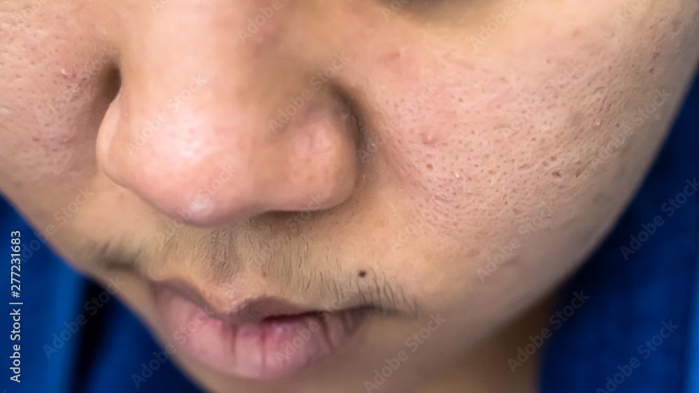 Facial acne is Asian women aged 25-30 and pores wrinkles are allergic to cosmetics. Facial acne is Asian women aged 25-30 and pores wrinkles are allergic to cosmetics.