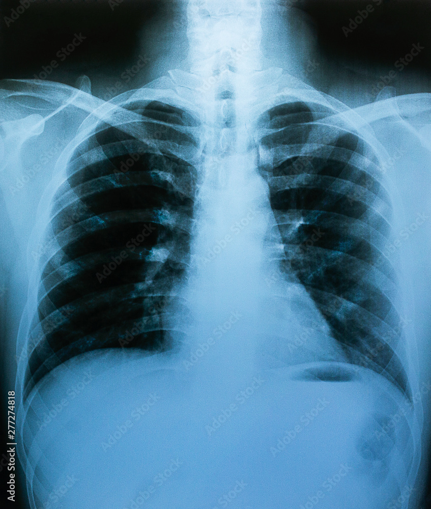 X-ray film, lung and bone structure, health examination X-ray film, lung and bone structure, health examination