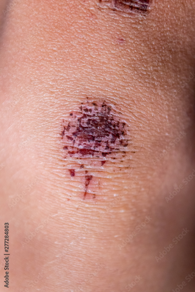 Schürfwunde am Knie eines Kindes mit roter Kruste aus Blut nach einem Ausrutscher beim Spielen und Toben in der Schule auf dem Pausenhof Schürfwunde am Knie eines Kindes mit roter Kruste aus Blut nach einem Ausrutscher beim Spielen und Toben in der Schule auf dem Pausenhof