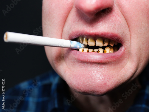 Cigarette in the man's mouth. Plaque teeth cavities and paradontosis. Smoking causes dental decay problems and bad smile. Dentist treatment concept. Harmful habit. © Vadym