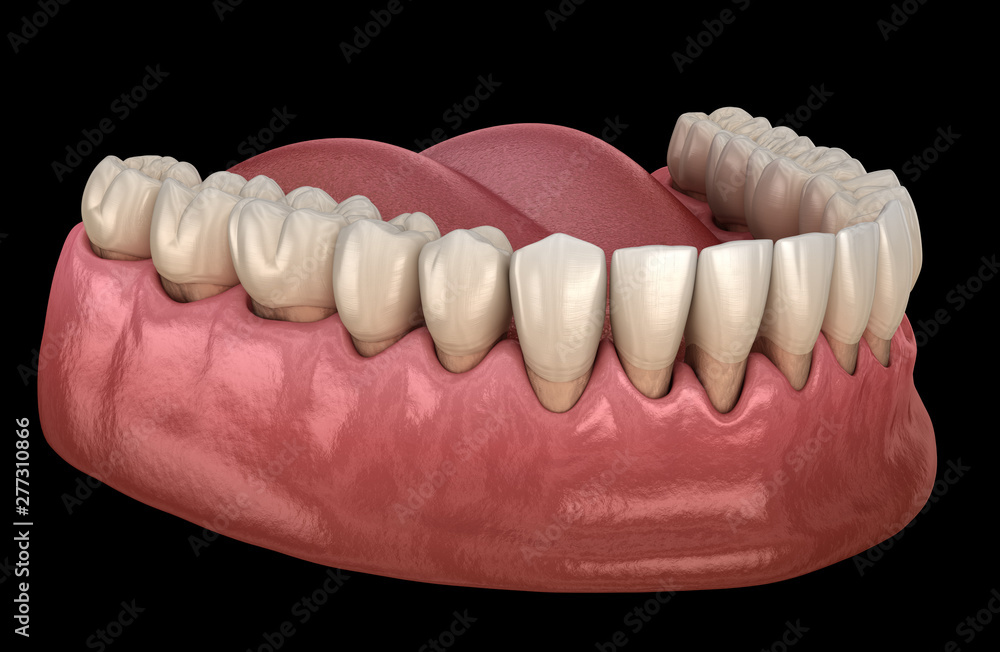 Gum recession process. Medically accurate 3D illustration Gum recession process. Medically accurate 3D illustration