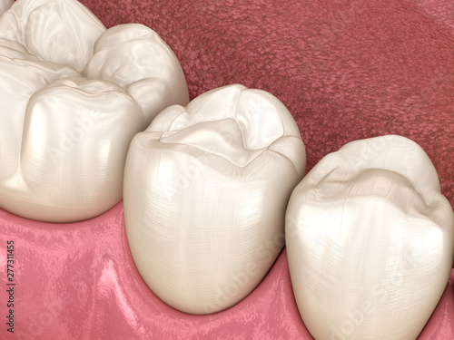 Fototapeta Naklejka Na Ścianę i Meble -  Premolar tooth restoration with filling. Medically accurate tooth 3D illustration.
