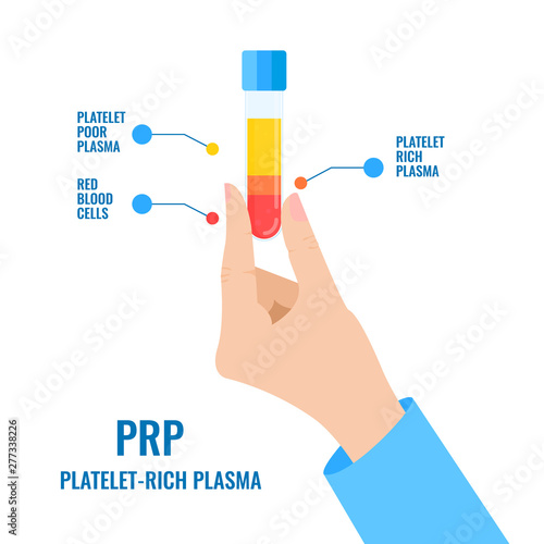 Doctor holding a test tube filled with blood for platelet rich plasma injection procedure. Hand showing PRP blood composition. Stem cell regenerative medicine concept. Medical vector illustration.