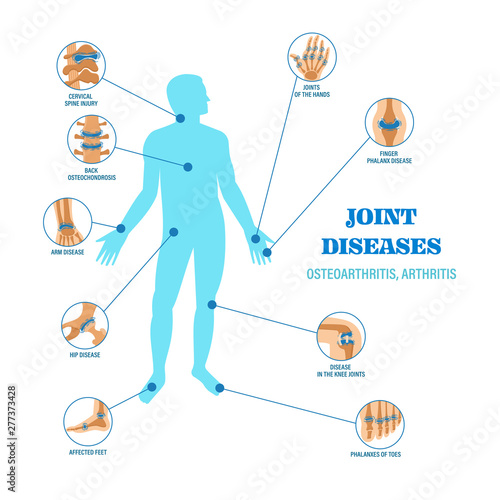 Joints diseases infographic banner vector illustration infographic design
